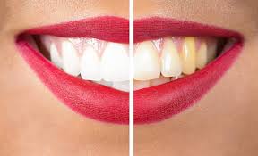 How Dental Fillings Can Help Restore Your Smile