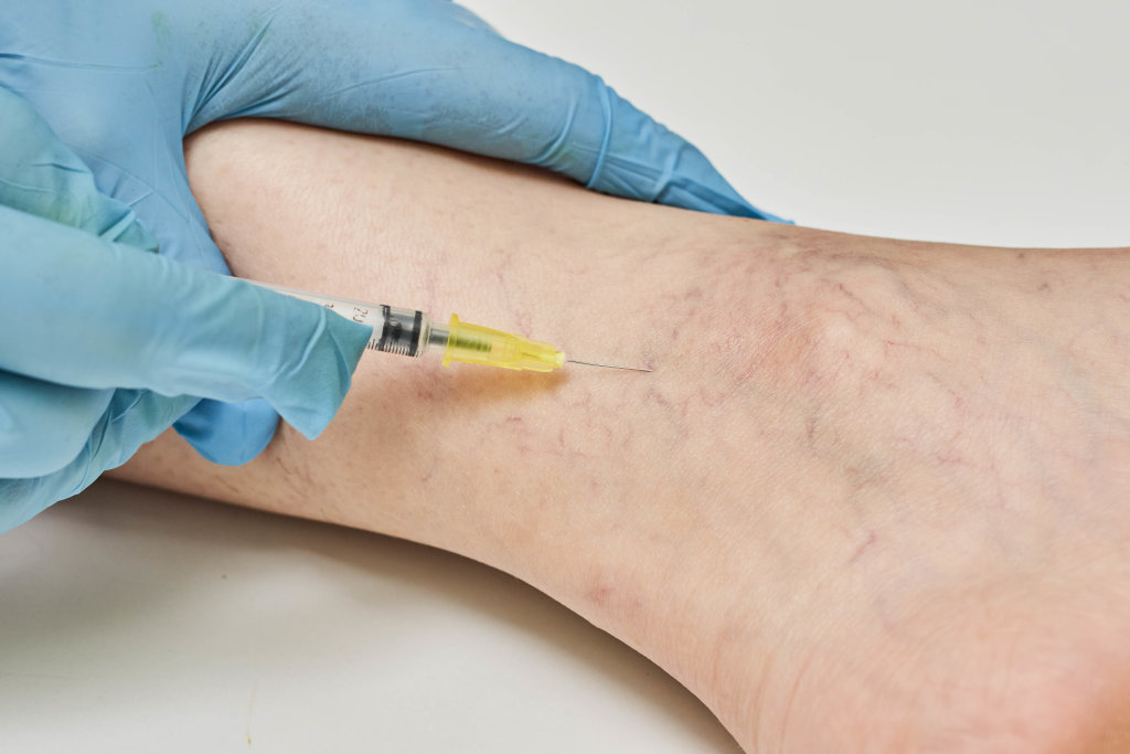 Sclerotherapy vs. Other Varicose Vein Treatments
