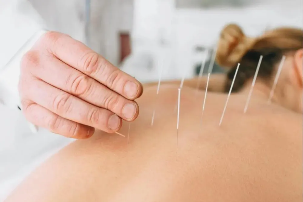 Acupuncture for Chronic Migraine Relief