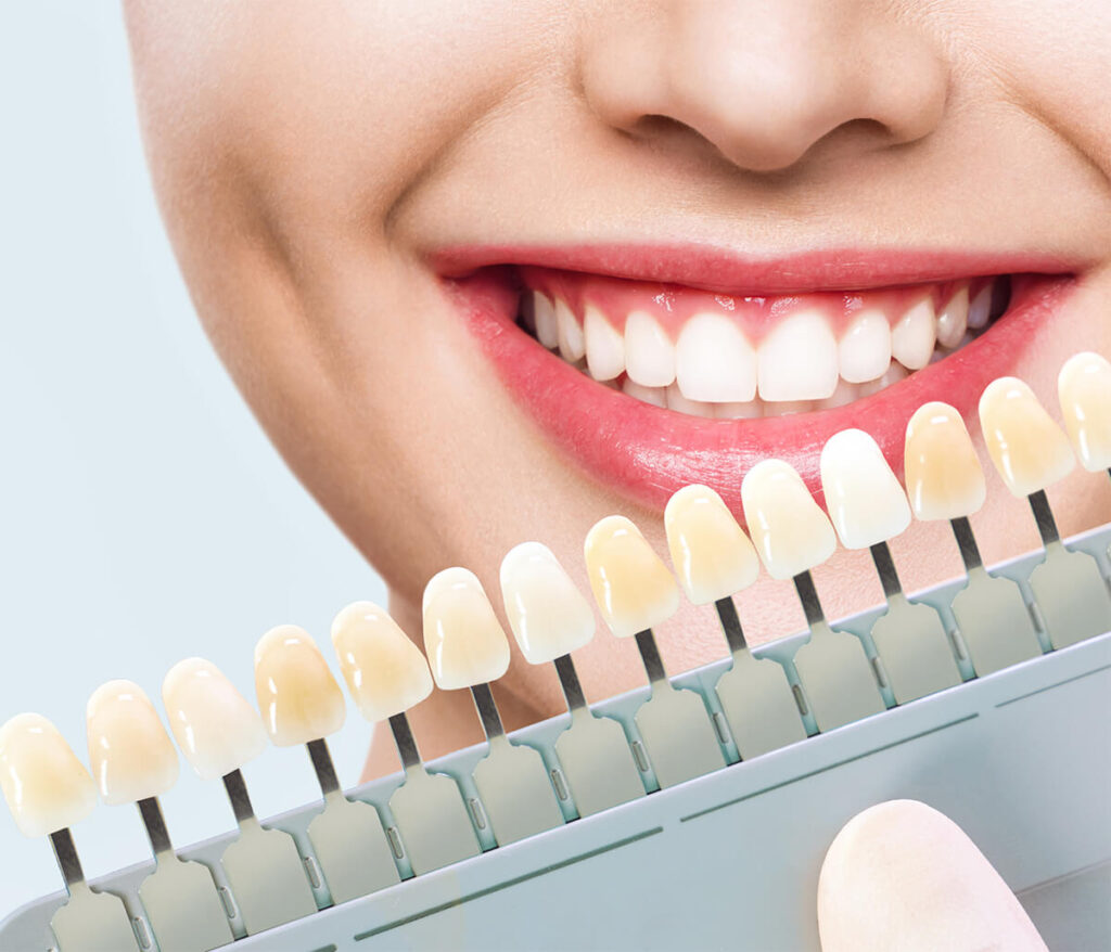 All About Veneers and Other Cosmetic Procedures