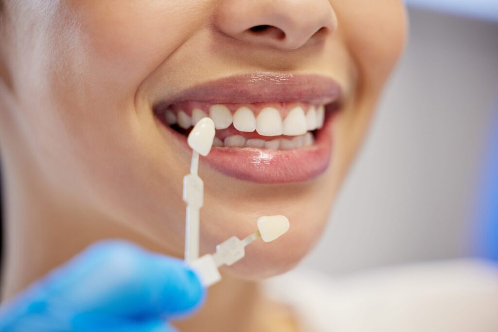 Are Veneers a Good Option for Stained or Damaged Teeth?