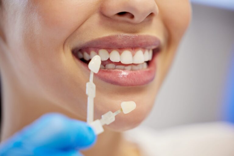 Are Veneers a Good Option for Stained or Damaged Teeth?