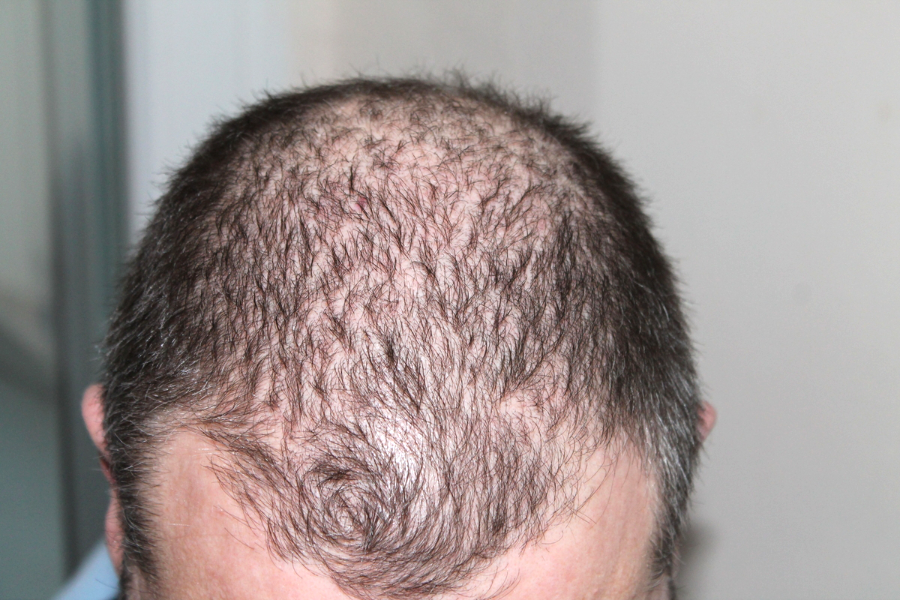 Effective Hair Loss Treatment Solutions for Thinning Hair