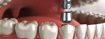 How Dental Implants Improve Quality of Life for Missing Teeth