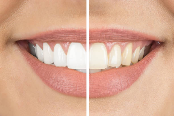 How Diet Affects Your Teeth Whitening Results