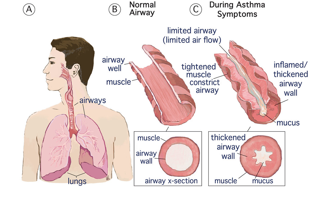 How Environmental Factors Can Trigger Asthma Symptoms