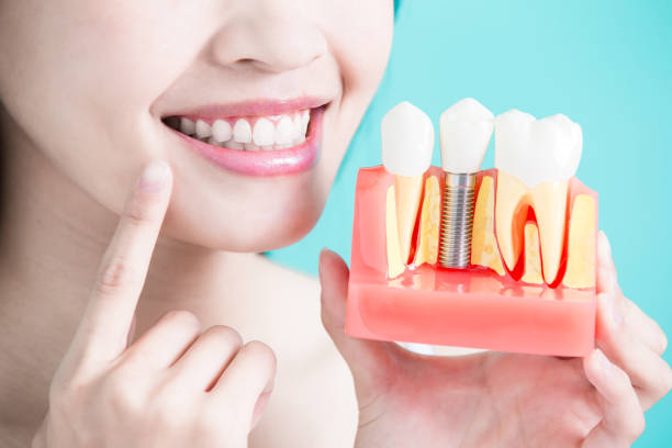 How To Prepare for Your Dental Implant