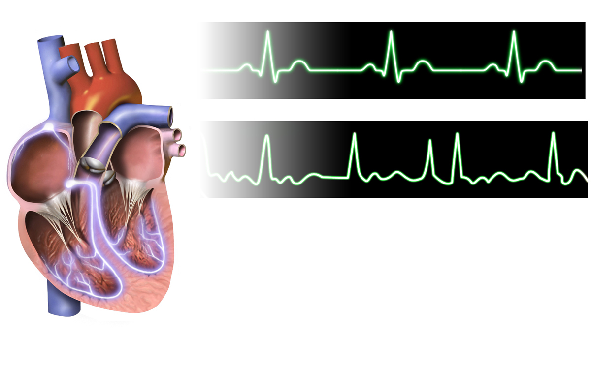 How a Cardiologist Diagnoses and Manages Atrial Fibrillation