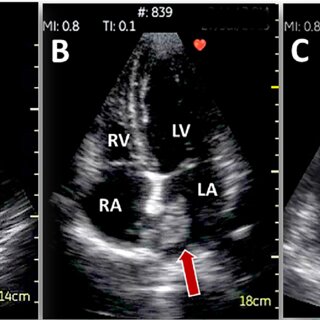 How an Echocardiogram Can Detect Heart Problems Early