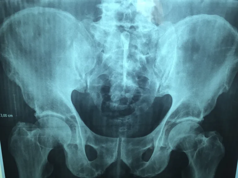 Is Kyphoplasty Right for Your Back Pain?