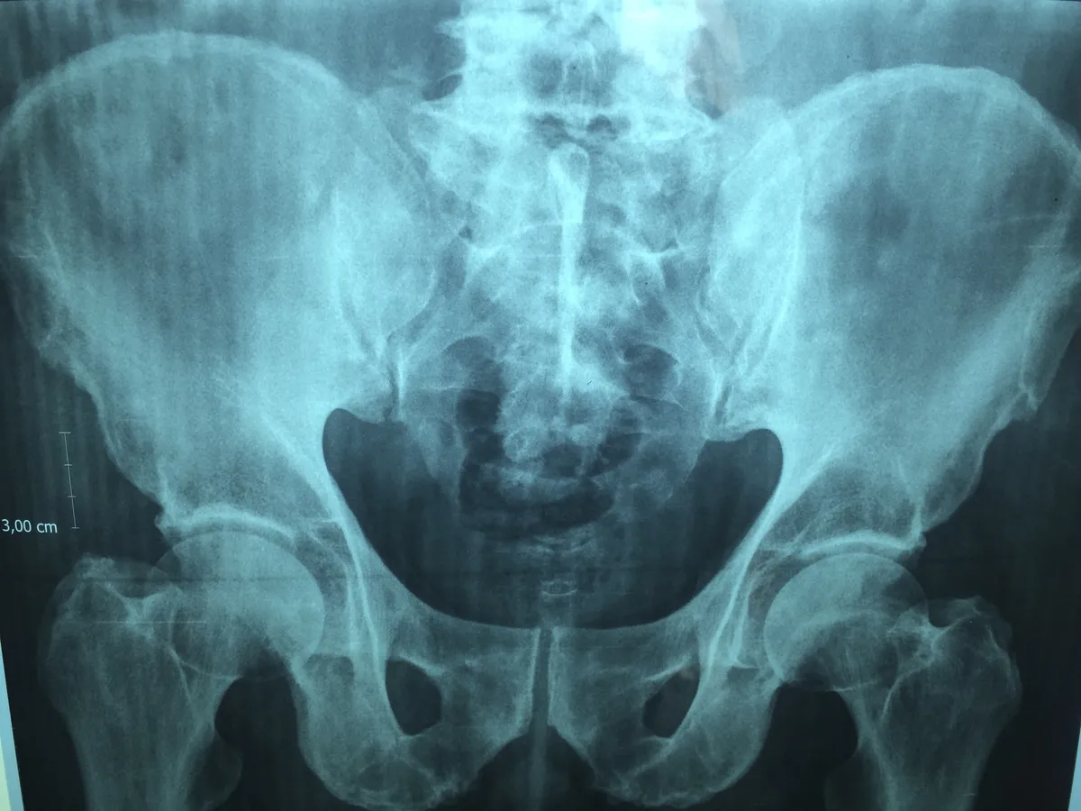 Is Kyphoplasty Right for Your Back Pain?