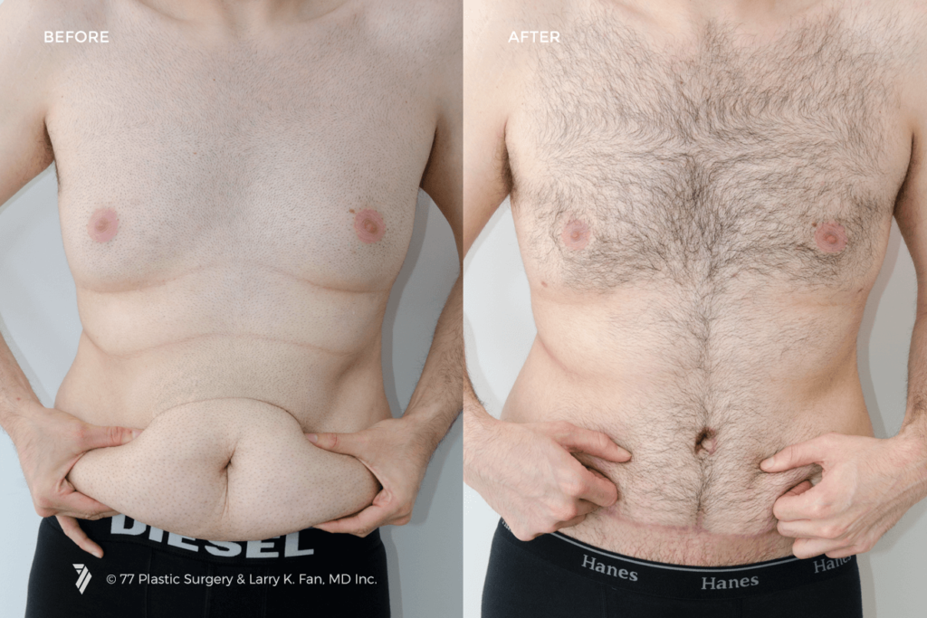 Panniculectomy vs. Tummy Tuck