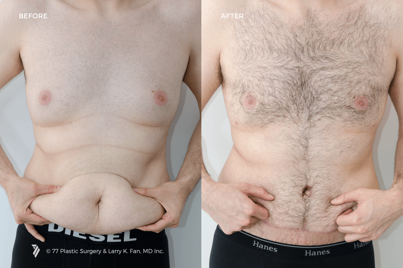 Panniculectomy vs. Tummy Tuck