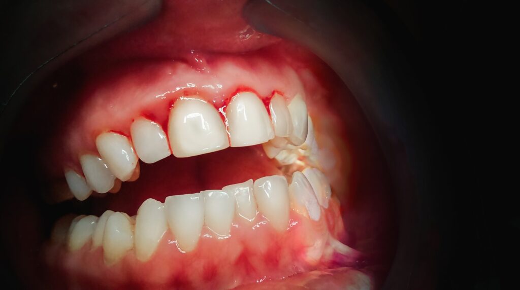 Signs You May Need Periodontal Treatment