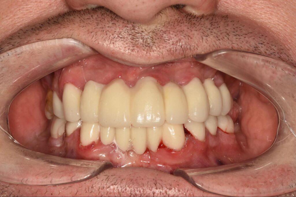 Solutions for Comfortable and Natural-Looking Tooth Restorations