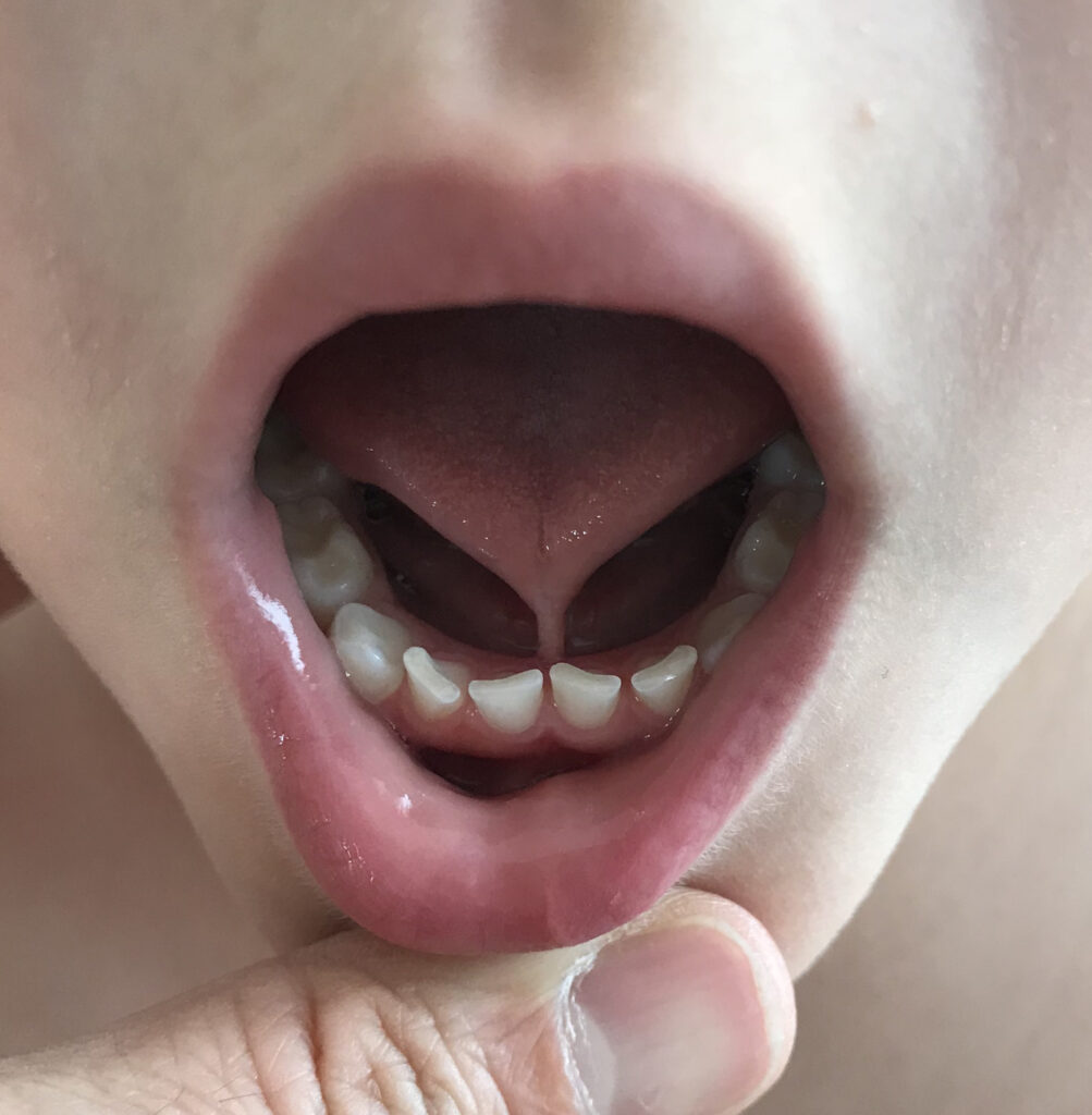 The Different Types of Tongue Ties and Their Impact on Development
