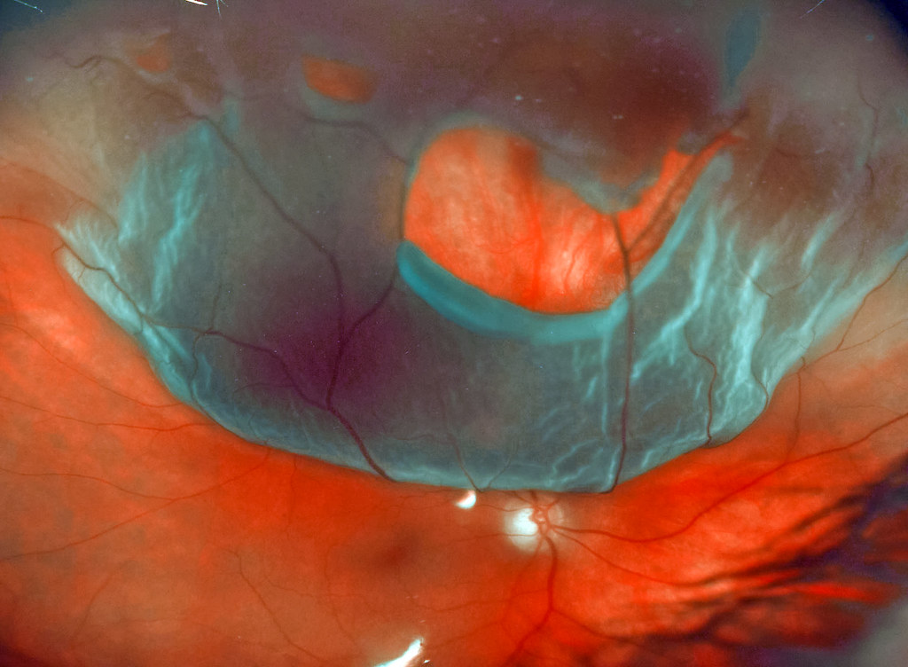 The Role of Genetics in Retinal Detachment