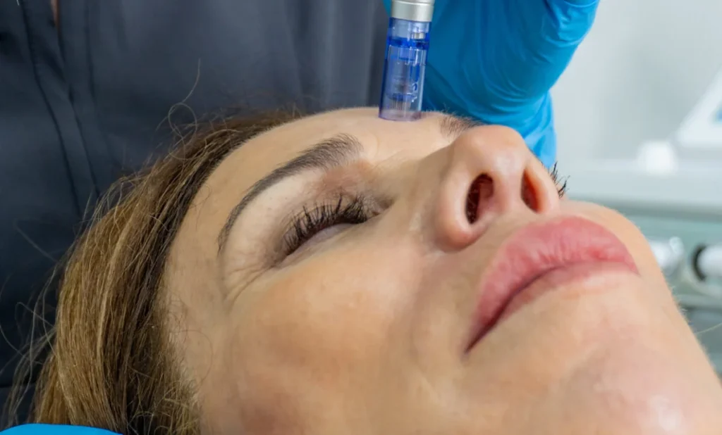 The Role of Microneedling in Addressing Hyperpigmentation