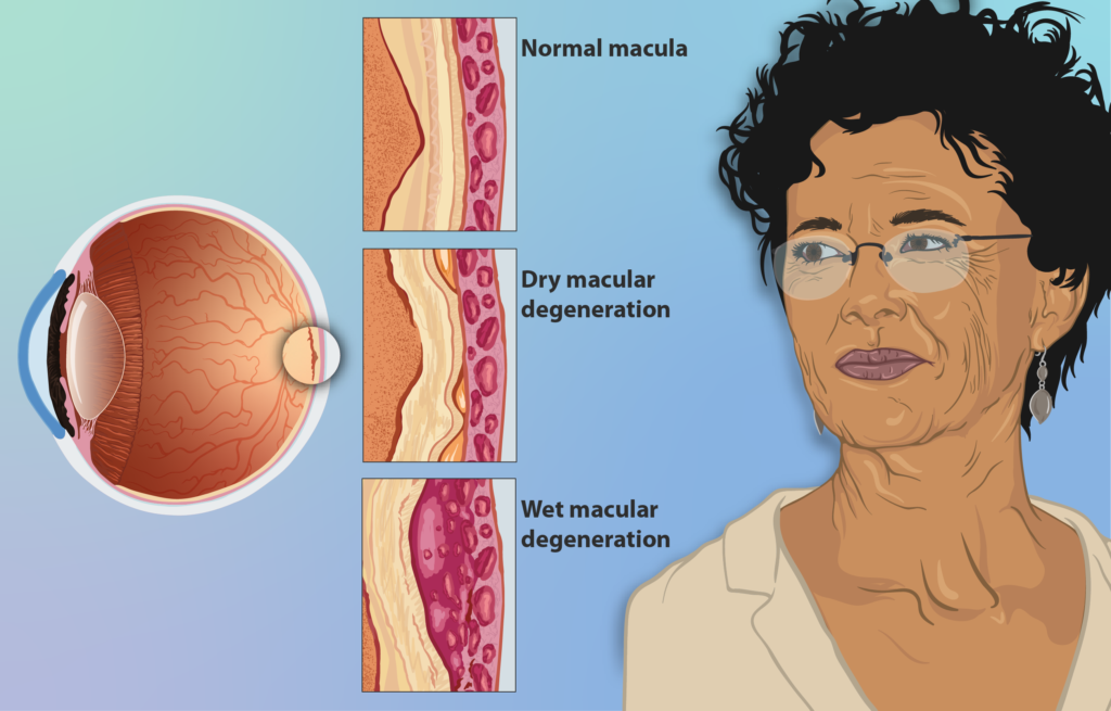Types and Treatments of Macular Degeneration