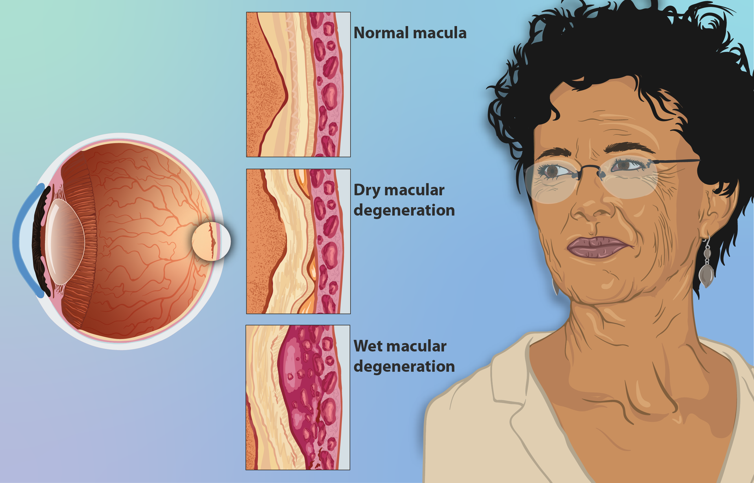 Types and Treatments of Macular Degeneration