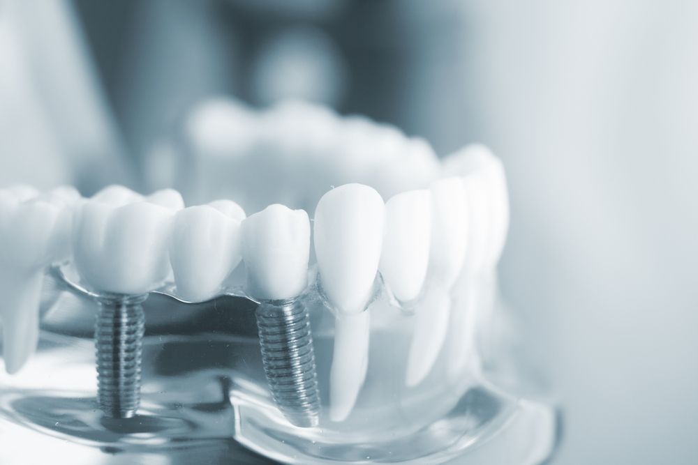 Understanding the Benefits and Process of Dental Implants