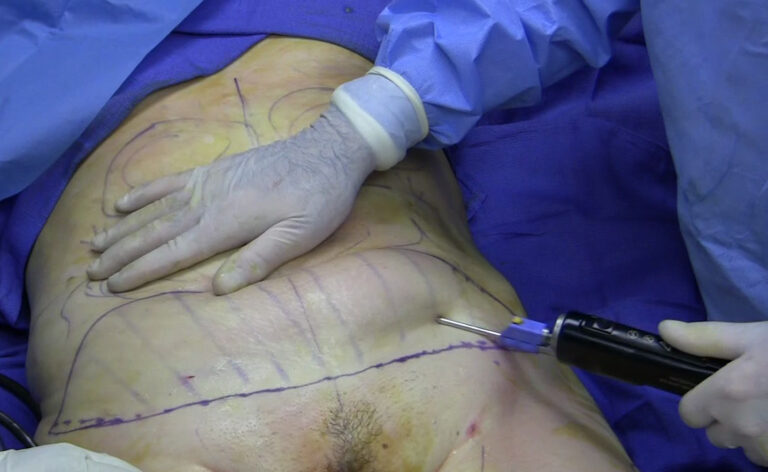 Understanding the Different Techniques of Liposuction