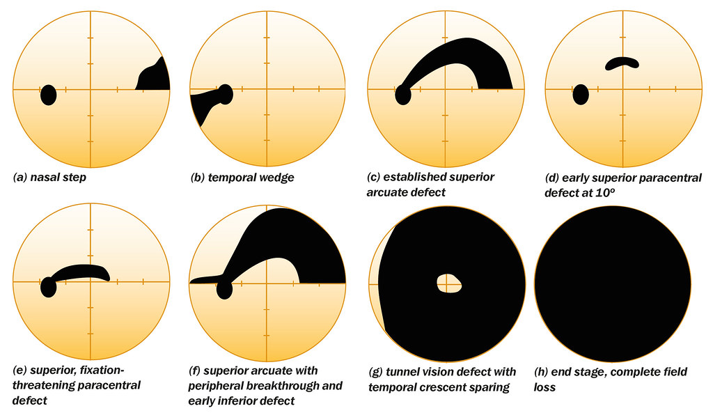 Understanding the Different Types of Glaucoma