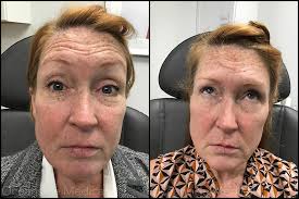 Understanding the Facelift Recovery Timeline