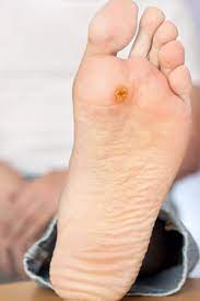 What Are Warts and What Causes Them?