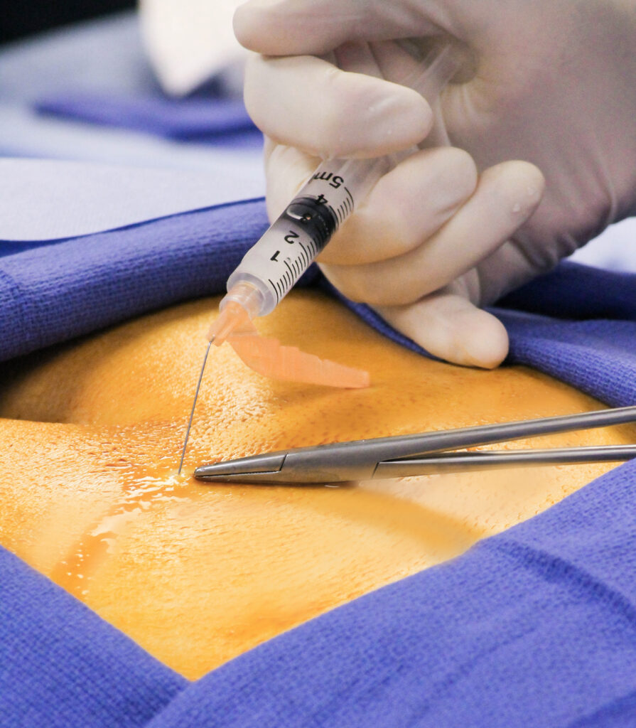 What To Expect During an Epidural Injection Procedure