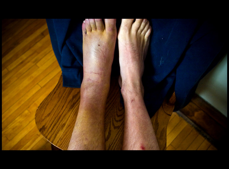 What You Should Know About Ankle Injury Recovery