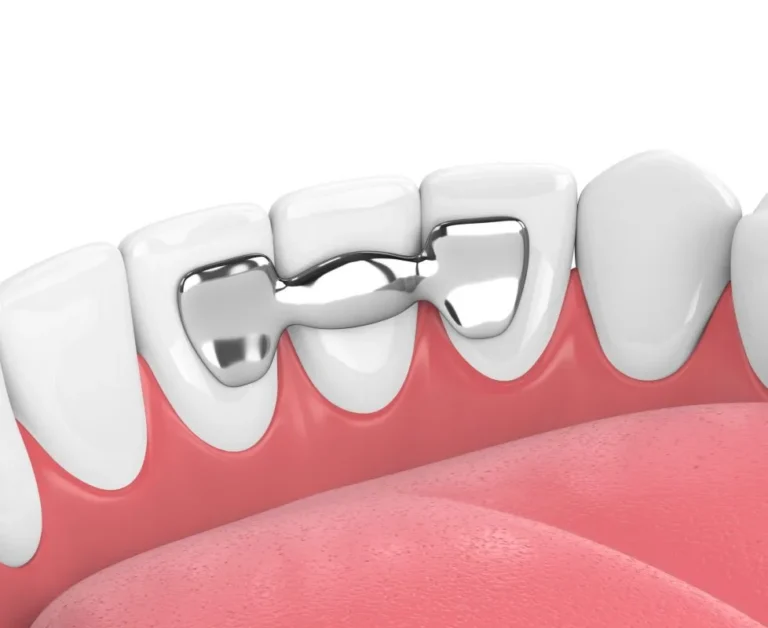 What is a Dental Bridge?
