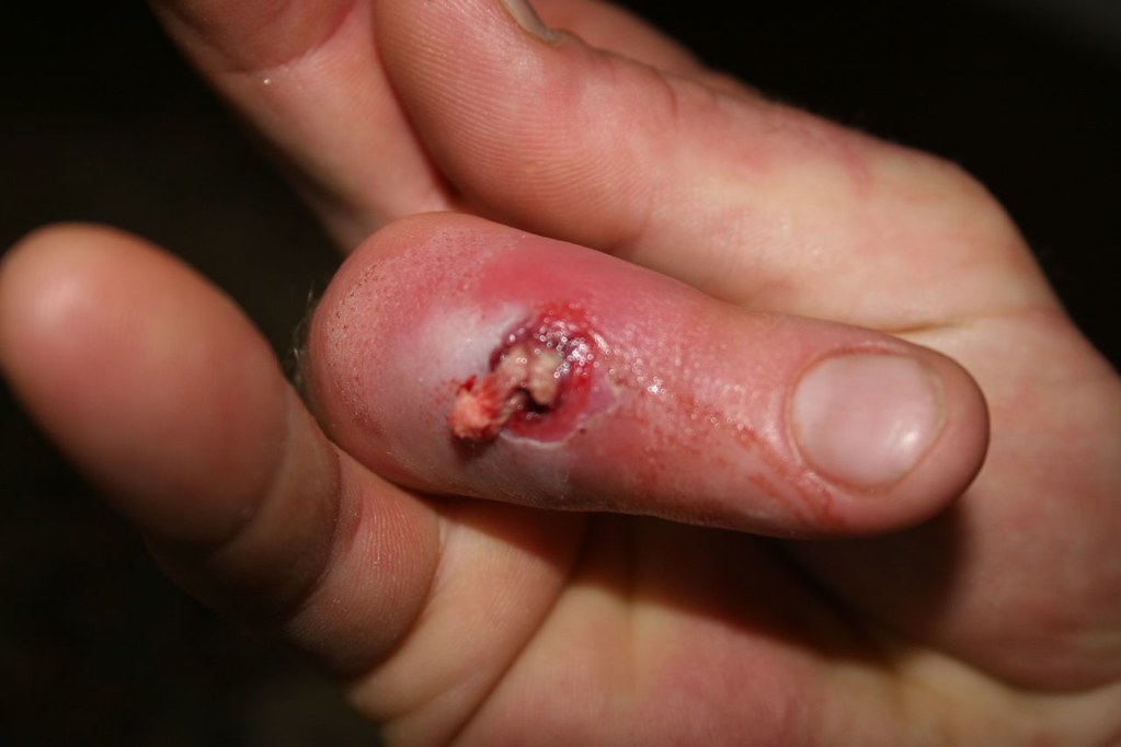 What to Do If You Notice an Infection in a Wound