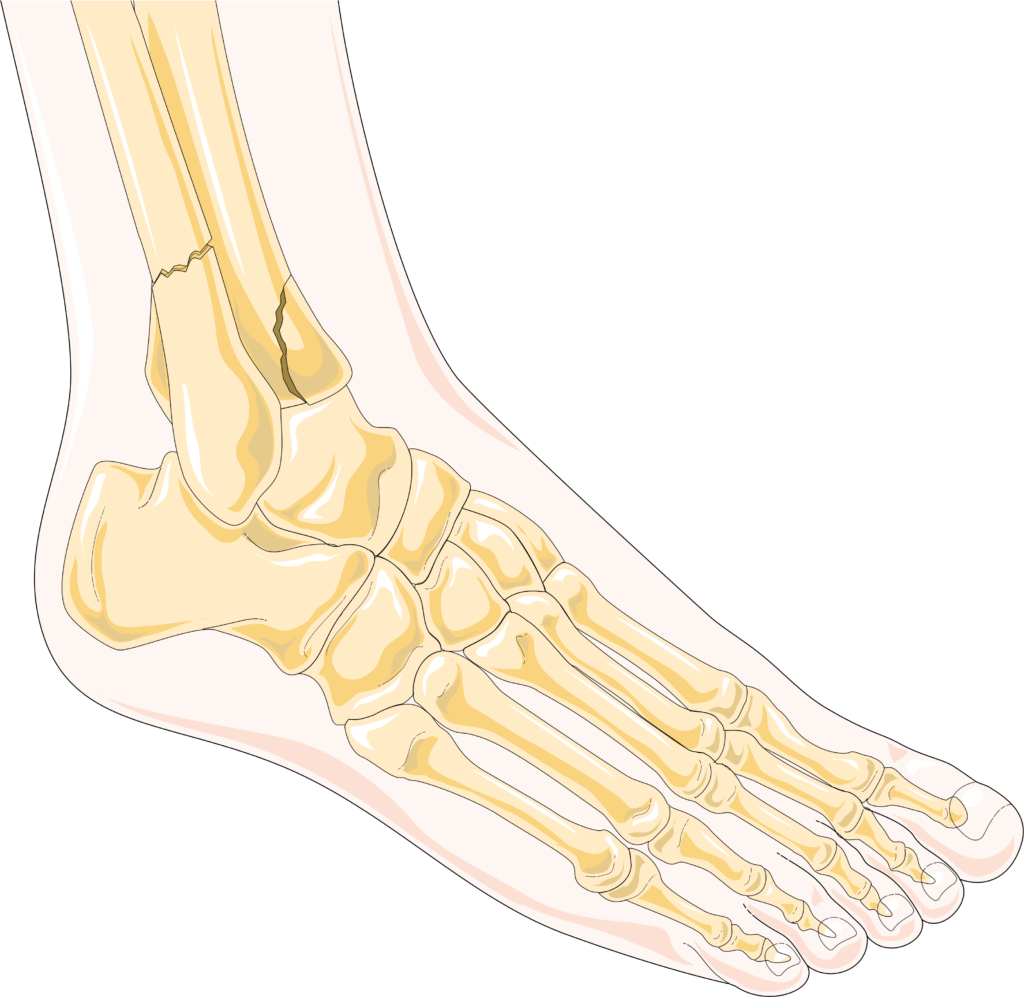 What to Expect During the Healing Process of an Ankle Fracture