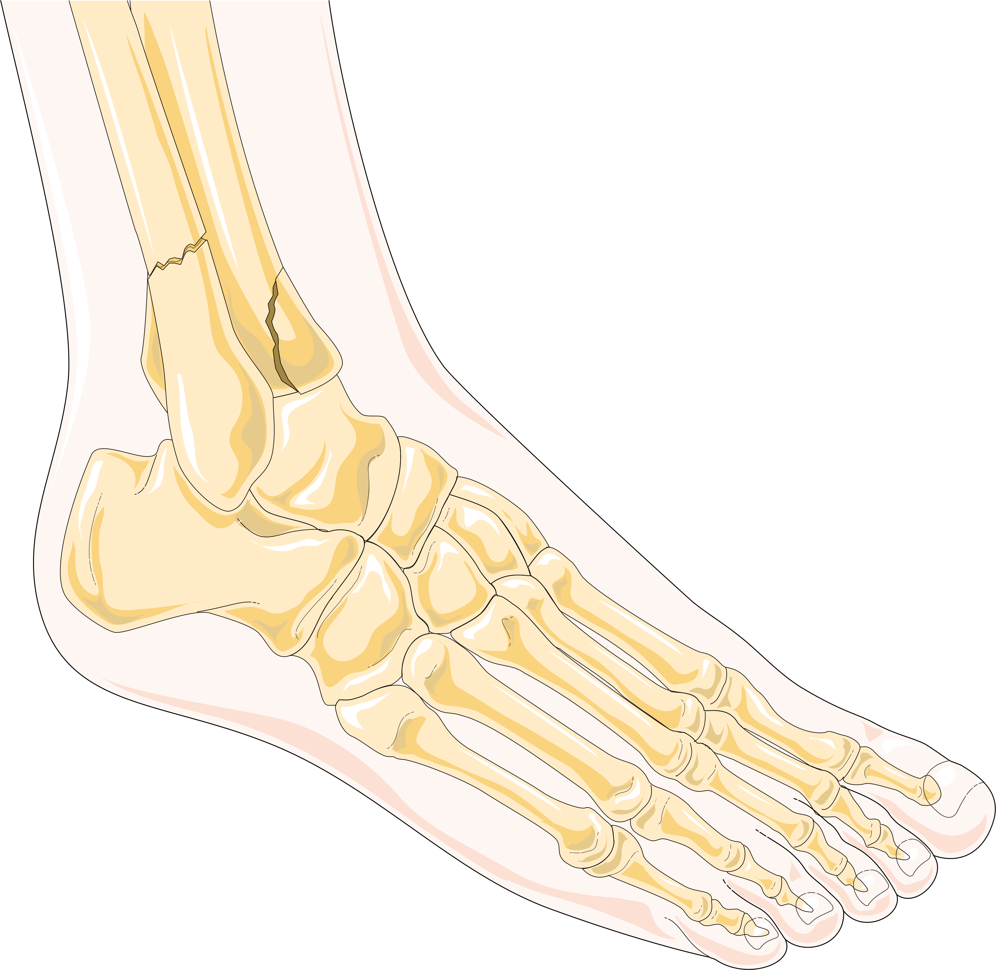 What to Expect During the Healing Process of an Ankle Fracture