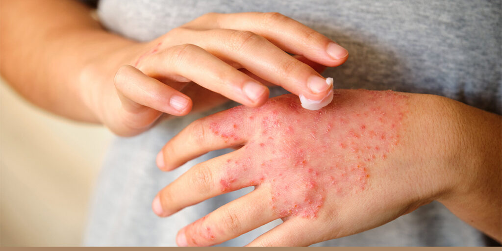 How to Manage Eczema Flare-Ups During Different Seasons