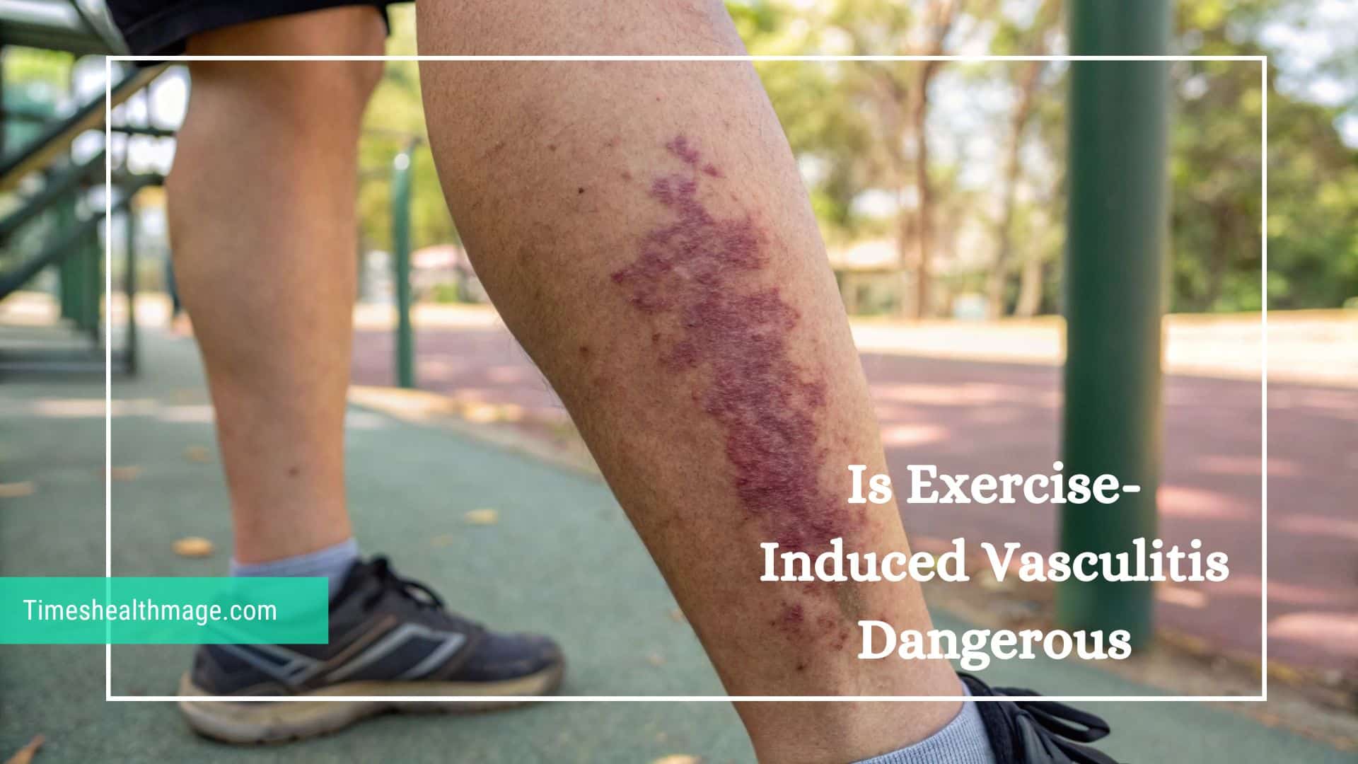 Is Exercise-Induced Vasculitis Dangerous