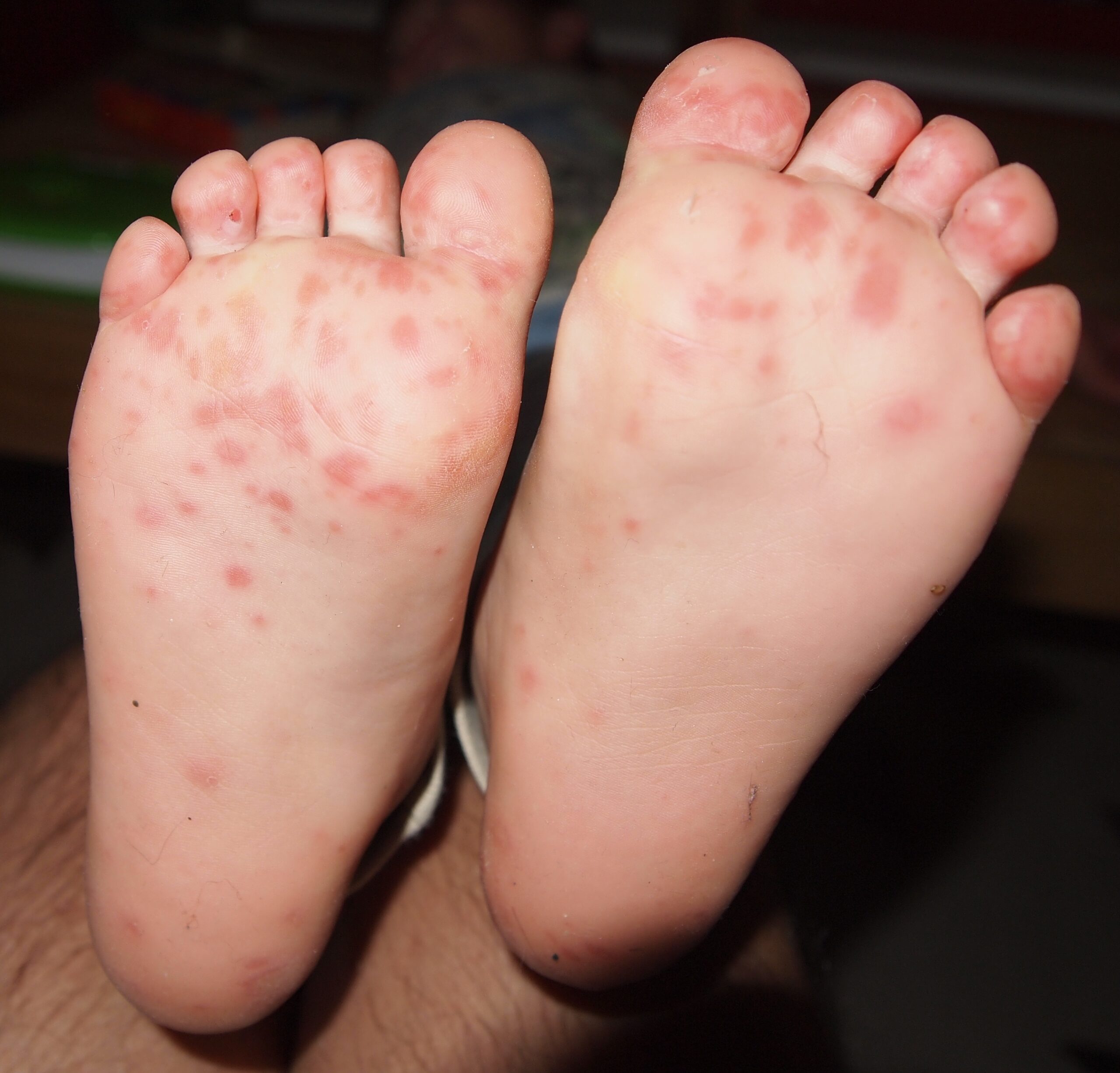 Plantar Warts in Children: What Parents Need To Know
