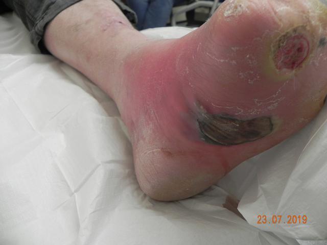 Preventing Complications in Diabetic Wound Care
