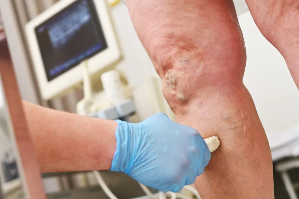 Common Causes and Treatments for Varicose Veins