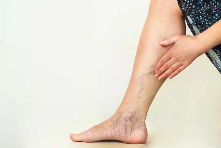 Lifestyle Changes To Manage Varicose Veins Symptoms